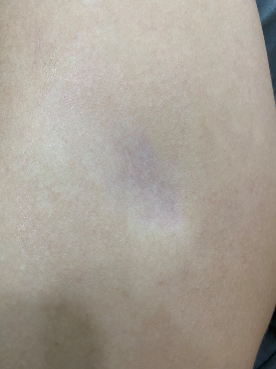 NHÂN MỘT TRƯỜNG HỢP TEO MÔ DƯỚI DA NHÂN MỘT TRƯỜNG HỢP TEO MÔ DƯỚI DA