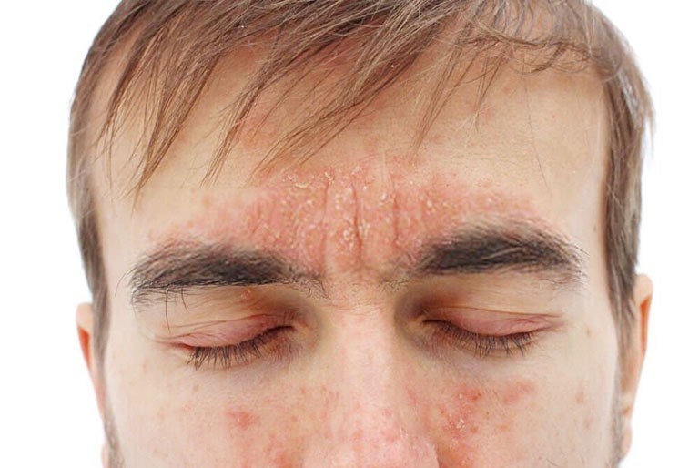 Vảy nến da mặt-bệnh da liễu mà mọi người không nên  chủ quan Vảy nến da mặt-bệnh da liễu mà mọi người không nên  chủ quan