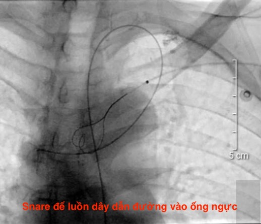 ĐÃ TÌM RA MỘT NGUYÊN NHÂN GÂY “ĐAU BỤNG KHÔNG RÕ NGUYÊN NHÂN”. ĐÃ TÌM RA MỘT NGUYÊN NHÂN GÂY “ĐAU BỤNG KHÔNG RÕ NGUYÊN NHÂN”.