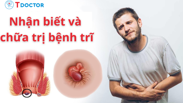 Nhận biết bệnh trĩ và cách điều trị trĩ hiệu quả nhất hiện nay Nhận biết bệnh trĩ và cách điều trị trĩ hiệu quả nhất hiện nay