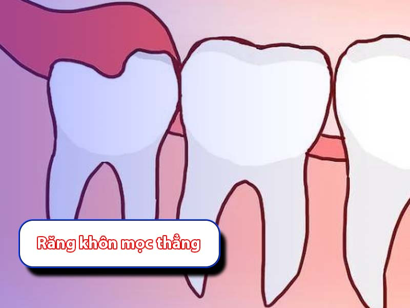 Răng khôn mọc thẳng: Nguy Cơ, Biến Chứng & Cách xử lý  Răng khôn mọc thẳng: Nguy Cơ, Biến Chứng & Cách xử lý