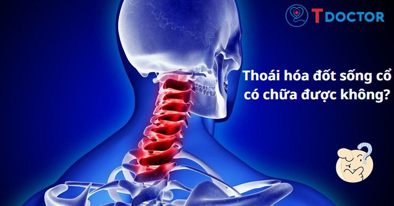 Thoái hóa đốt sống cổ: Nguyên nhân, triệu chứng và cách chữa trị Thoái hóa đốt sống cổ: Nguyên nhân, triệu chứng và cách chữa trị