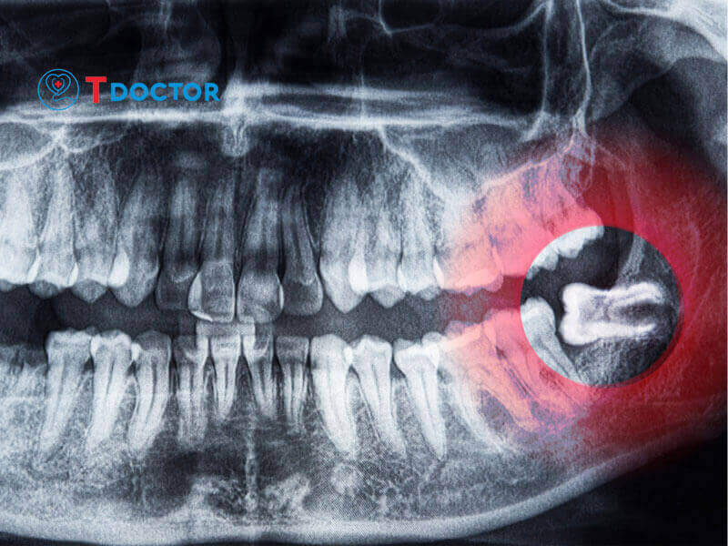 Nhổ Răng Số 8 Giá Bao Nhiêu? Giá nhổ răng tại HN và tp.HCM Nhổ Răng Số 8 Giá Bao Nhiêu? Giá nhổ răng tại HN và tp.HCM
