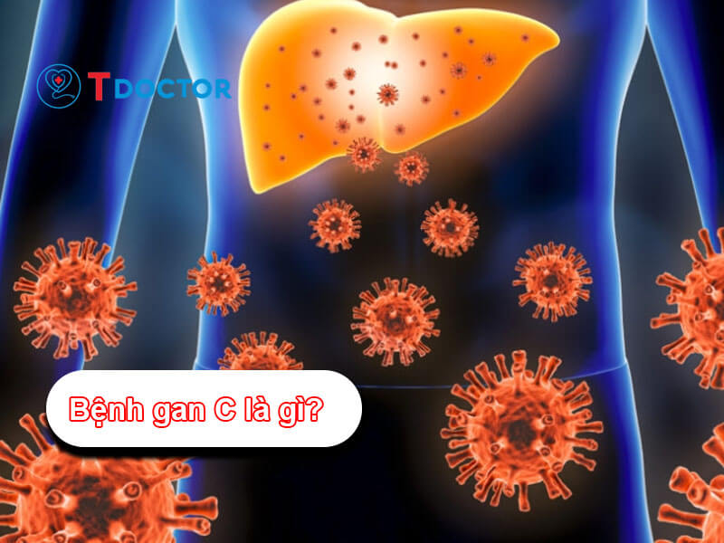 Bệnh gan C là gì? Điều trị và phòng ngừa viêm gan C như nào? Bệnh gan C là gì? Điều trị và phòng ngừa viêm gan C như nào?