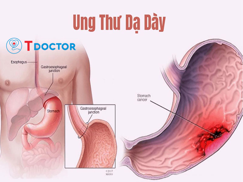 Ung thư dạ dày: Nguyên nhân và những điều cần phải biết Ung thư dạ dày: Nguyên nhân và những điều cần phải biết