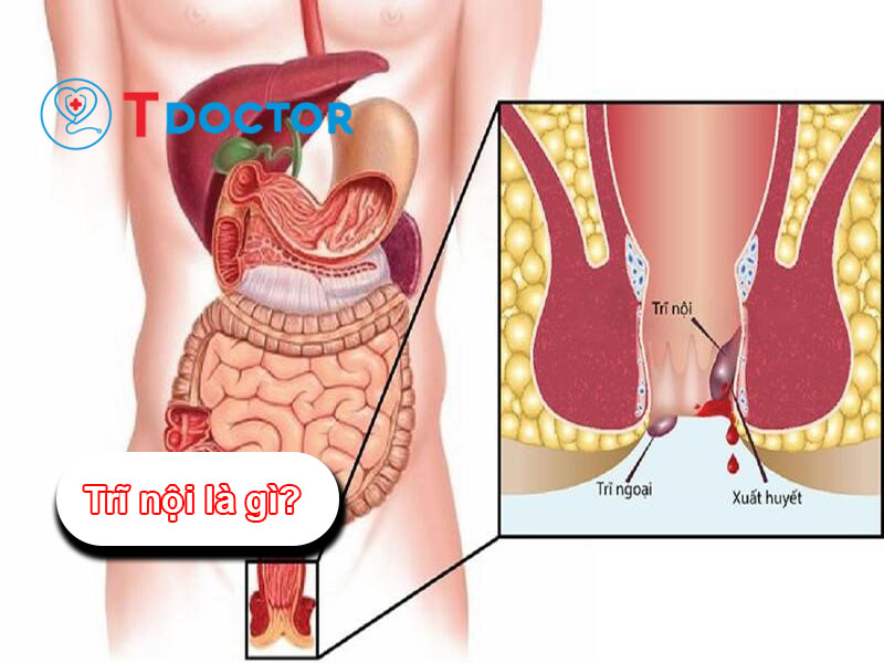 Trĩ nội là gì? Nguyên nhân và cách điều trị bệnh An Toàn Trĩ nội là gì? Nguyên nhân và cách điều trị bệnh An Toàn