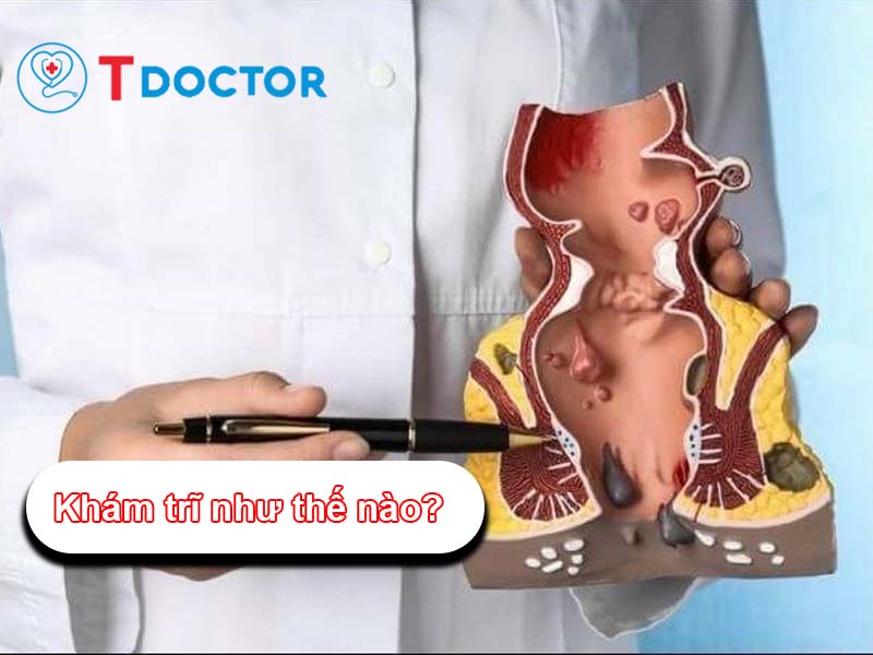 Chia sẻ khám trĩ như thế nào? và chuẩn bị gì trước khi khám trĩ Chia sẻ khám trĩ như thế nào? và chuẩn bị gì trước khi khám trĩ