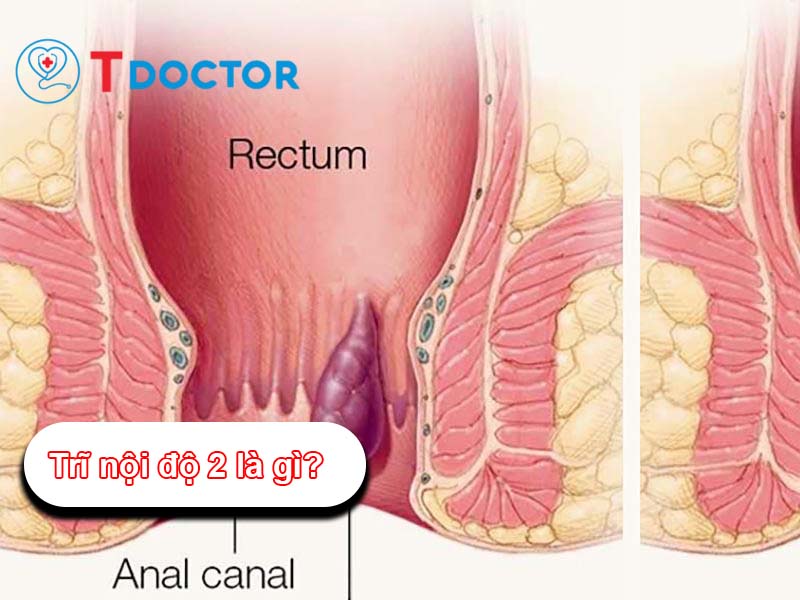 Trĩ nội độ 2: các dấu hiệu và cách điều trị Trĩ nội độ 2: các dấu hiệu và cách điều trị