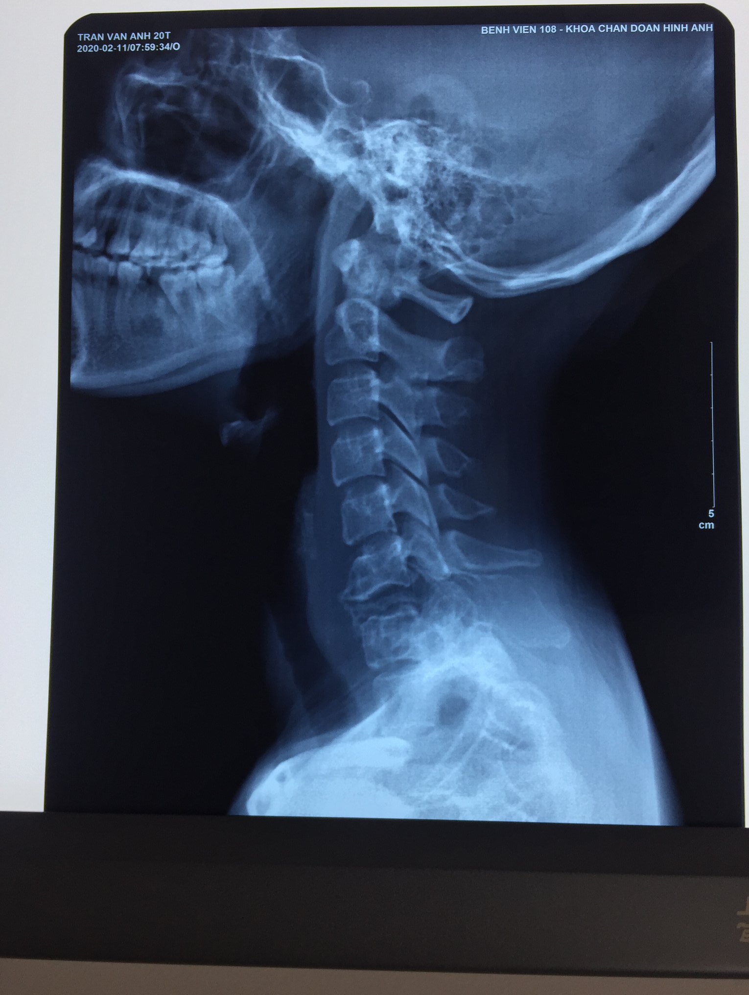 CA PHẪU THUẬT KHÓ KHĂN NHẤT TRONG  CHUYÊN NGÀNH CỘT SỐNG