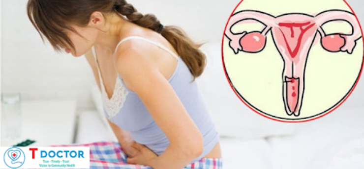 Cách nhận biết bạn đang mắc ung thư cổ tử cung