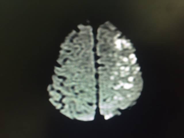 TAI BIẾN DO TIÊM CHẤT LÀM ĐẦY