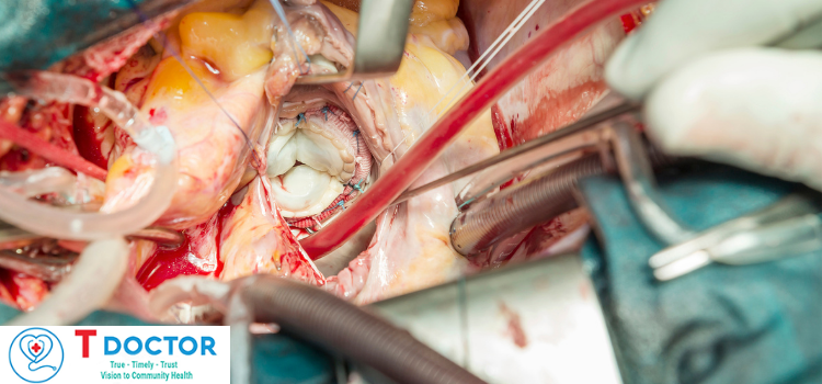 Hở van 2 lá 1/4 có nguy hiểm không? Nguyên nhân và cách điều trị