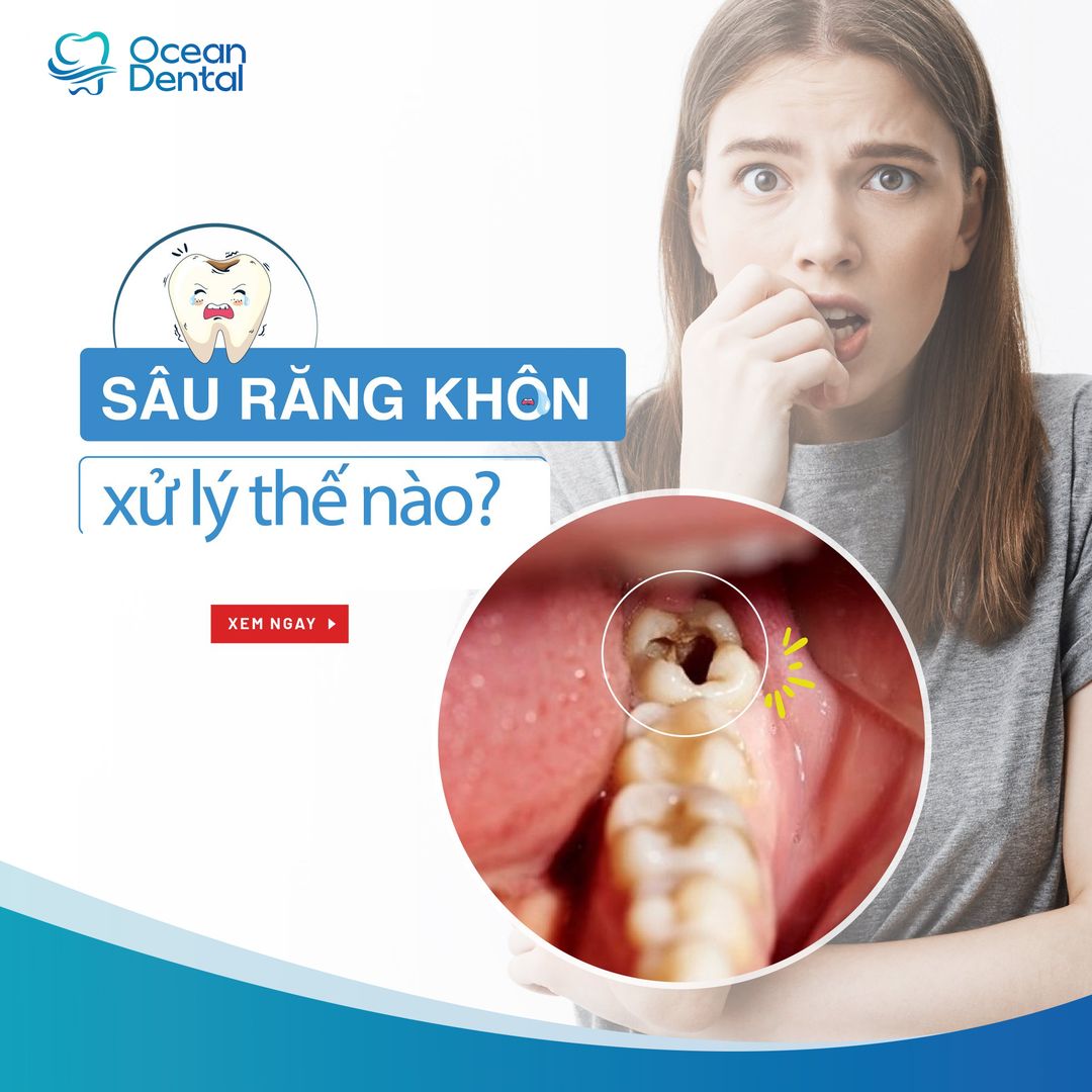 RĂNG KHÔN BỊ SÂU NÊN XỬ LÝ NHƯ THẾ NÀO?