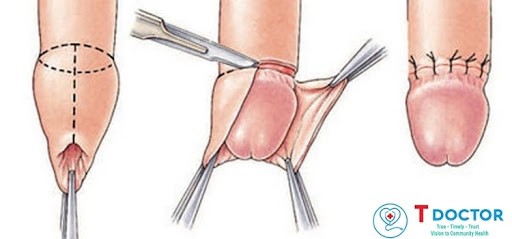 Hẹp bao quy đầu có nên cắt không ?