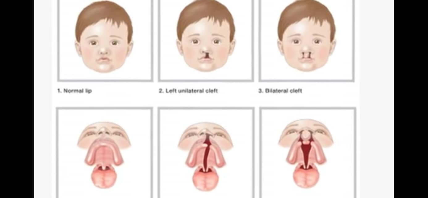 Hở hàm ếch và chẩn đoán sớm trên siêu âm thai quý I